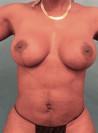Breast Lift Patient #4 After Photo Thumbnail # 2