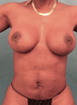 Breast Lift Patient #4 After Photo # 2