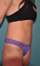 Abdominoplasty/ Tummy Tuck Patient #2 After Photo Thumbnail # 4