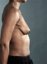 Breast Lift Patient #4 Before Photo Thumbnail # 9