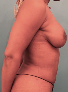 Breast Lift Patient #4 After Photo # 10