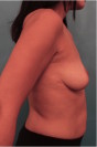 Breast Lift Patient #2 After Photo Thumbnail # 6