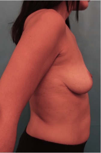 Breast Lift Patient #2 After Photo # 6