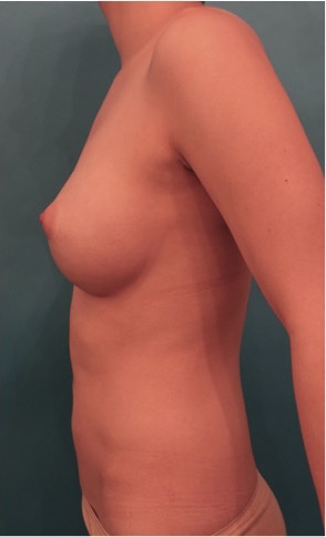 Breast Augmentation (Implants) Patient #2 After Photo # 6