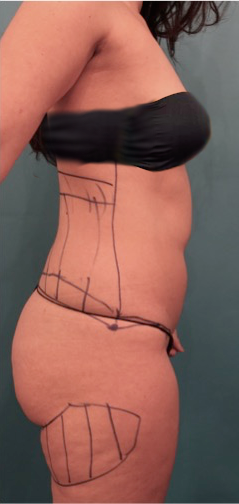 Liposuction Patient #2 Before Photo Thumbnail # 9