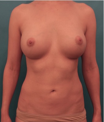 Breast Augmentation (Implants) Patient #2 After Photo # 2