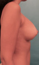 Breast Augmentation (Implants) Patient #3 After Photo Thumbnail # 10