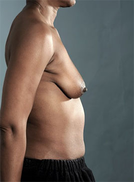 Breast Augmentation (Implants) Patient #7 Before Photo # 9