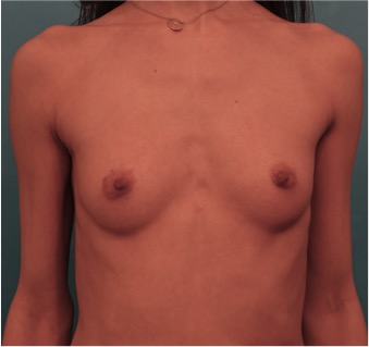 Breast Augmentation (Implants) Patient #1 Before Photo # 1