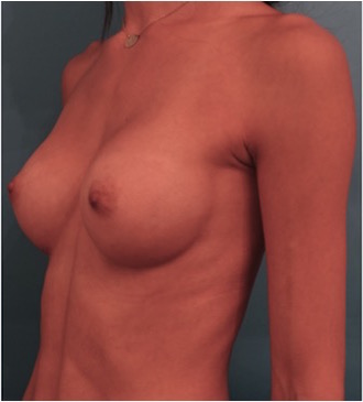 Breast Augmentation (Implants) Patient #1 After Photo # 4