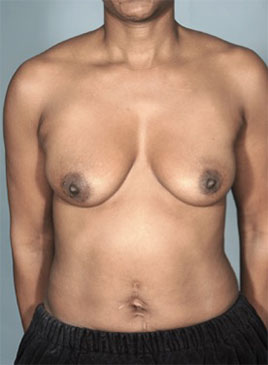 Breast Augmentation (Implants) Patient #7 Before Photo # 1