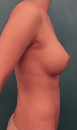 Breast Augmentation (Implants) Patient #2 After Photo # 10