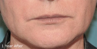 Laser Resurfacing Patient #2 After Photo # 6