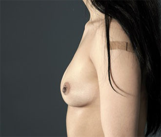 Breast Augmentation (Implants) Patient #4 Before Photo # 9
