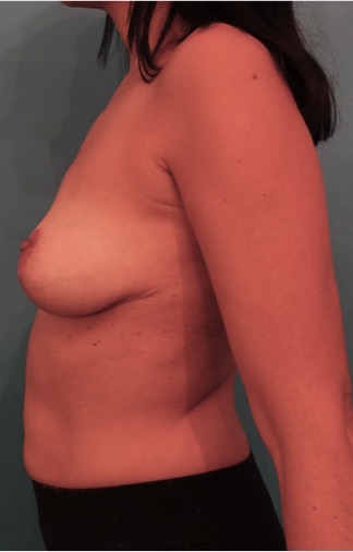 Breast Lift Patient #2 After Photo # 10