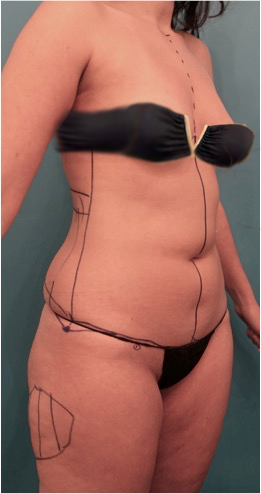 Liposuction Patient #2 Before Photo # 5