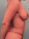 Breast Augmentation (Implants) Patient #7 After Photo Thumbnail # 10