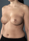 Breast Augmentation (Implants) Patient #3 Before Photo Thumbnail # 3