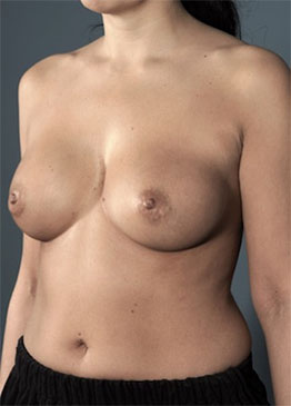 Breast Augmentation (Implants) Patient #3 Before Photo # 3