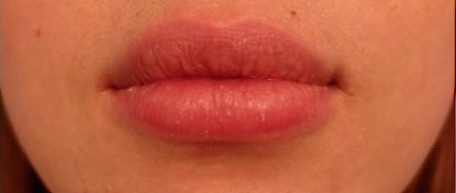 Lip Filler Patient #1 After Photo # 2