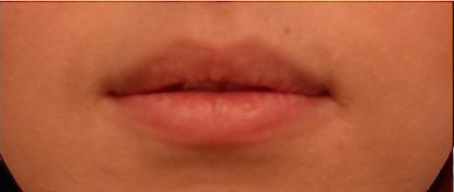 Lip Filler Patient #1 Before Photo # 1