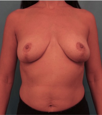 Breast Lift Patient #2 After Photo # 2