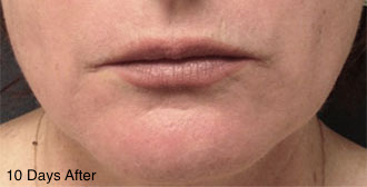 Laser Resurfacing Patient #2 After Photo # 2