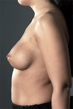 Breast Augmentation (Implants) Patient #3 Before Photo # 5