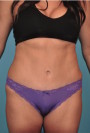 Abdominoplasty/ Tummy Tuck Patient #2 After Photo Thumbnail # 2