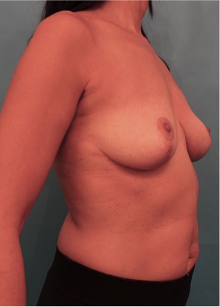 Breast Lift Patient #2 After Photo # 4
