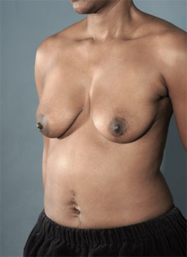 Breast Lift Patient #4 Before Photo # 3