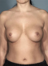 Breast Augmentation (Implants) Patient #3 Before Photo Thumbnail # 1