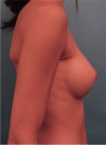 Breast Augmentation (Implants) Patient #1 After Photo Thumbnail # 10