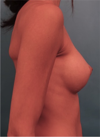 Breast Augmentation (Implants) Patient #1 After Photo # 10