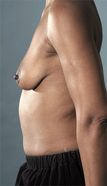 Breast Lift Patient #4 Before Photo # 5