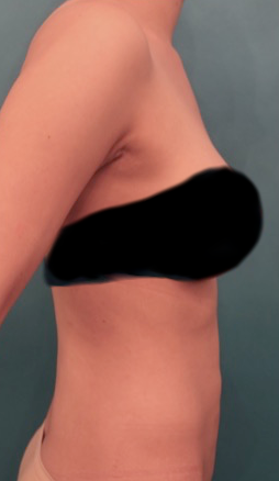 Liposuction Patient #3 After Photo Thumbnail # 12