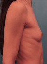 Breast Augmentation (Implants) Patient #1 Before Photo Thumbnail # 9