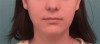 Kybella Patient #1 After Photo Thumbnail # 2