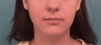 Kybella Patient #1 After Photo # 2