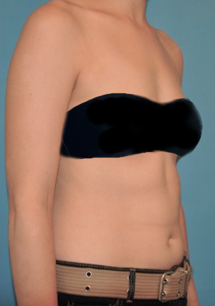 Liposuction Patient #3 Before Photo Thumbnail # 9
