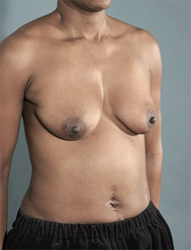 Breast Lift Patient #4 Before Photo # 7