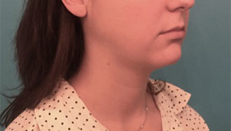 Kybella Patient #1 After Photo # 8