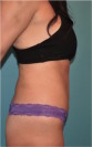 Abdominoplasty/ Tummy Tuck Patient #2 After Photo Thumbnail # 6