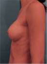 Breast Augmentation (Implants) Patient #1 After Photo Thumbnail # 6