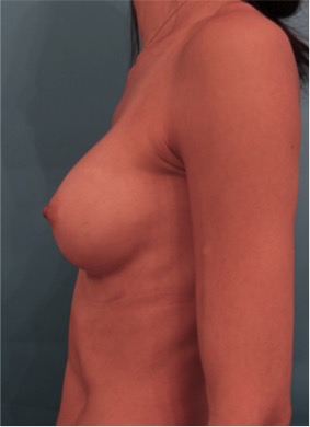 Breast Augmentation (Implants) Patient #1 After Photo # 6