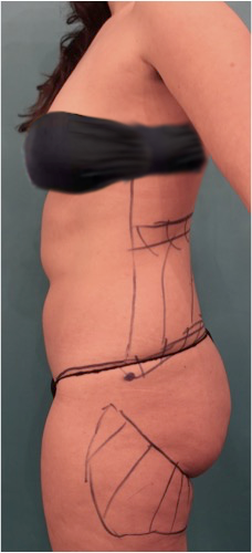 Liposuction Patient #2 Before Photo Thumbnail # 13