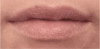 Lip Filler Patient #2 Before Photo Thumbnail # 1