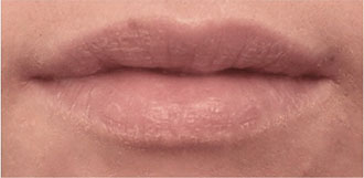 Lip Filler Patient #2 Before Photo # 1