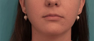 Kybella Patient #1 Before Photo # 1