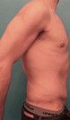 Abdominoplasty/ Tummy Tuck Patient #3 After Photo Thumbnail # 6